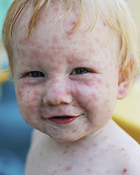 Photo of child's face covered in chickenpox (varicella)